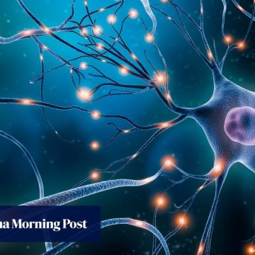 UK scientists slow Huntington’s disease for first time