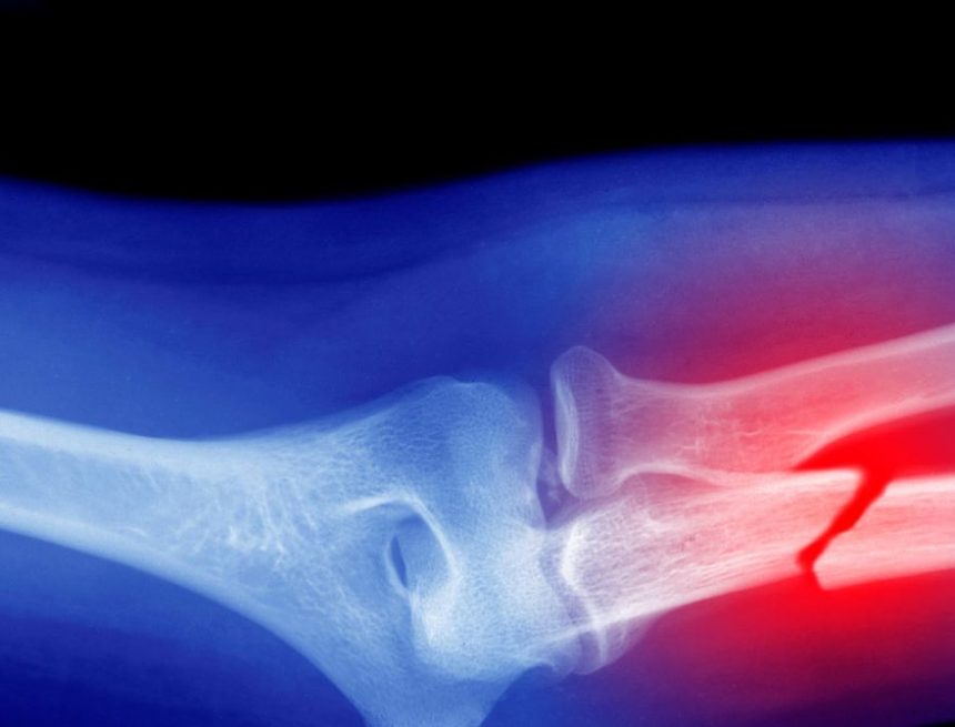 Microplastics Could Be Weakening Your Bones, Research Suggests