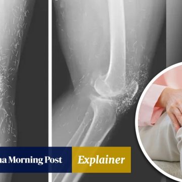 Explainer | Gold thread acupuncture uses gold wires for pain relief, could cause infections, tissue damage