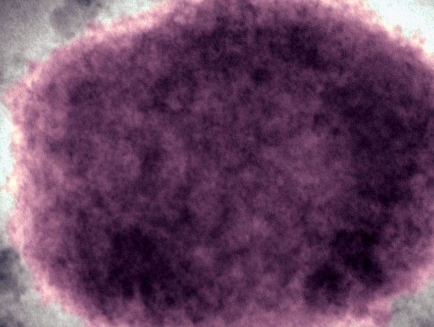 In 2022, the world axed a disease name seen as racist. US just switched back.