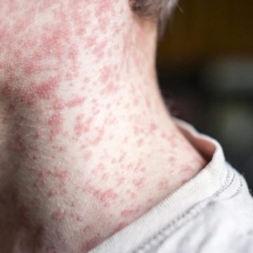 Measles outbreak in SC sends 150 unvaccinated kids into 21-day quarantine