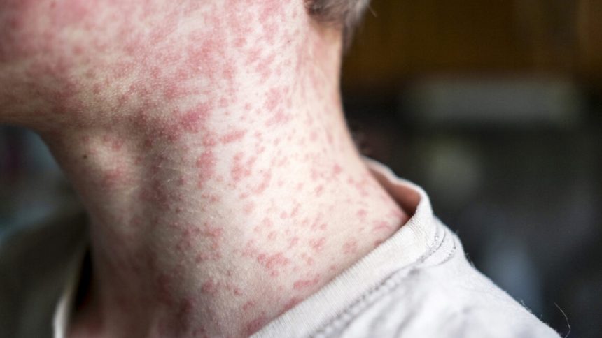 Measles outbreak in SC sends 150 unvaccinated kids into 21-day quarantine