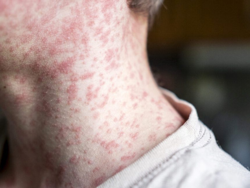 Measles outbreak in SC sends 150 unvaccinated kids into 21-day quarantine