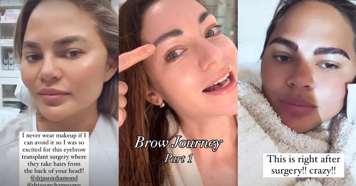 Inside a $20,000 Eyebrow Transplant